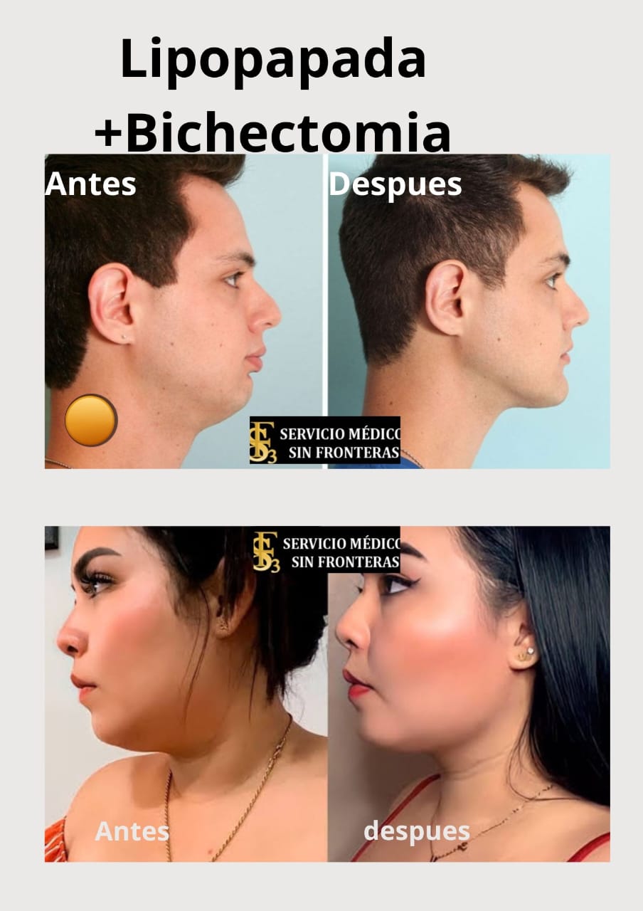 Resultado Combinado 1